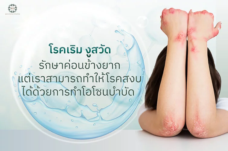 รักษาโรคเริม