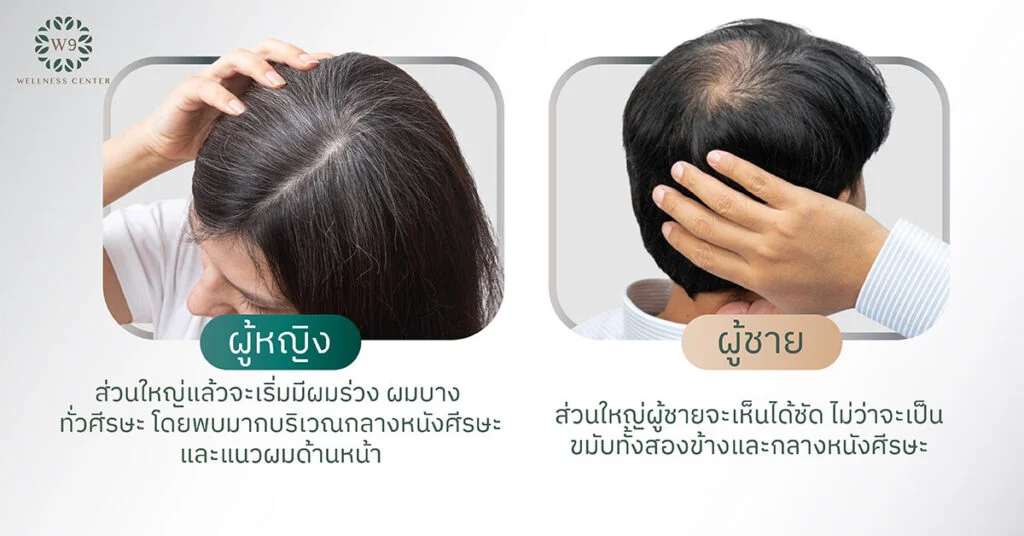 ผมร่วง ผมบาง ศีรษะล้าน