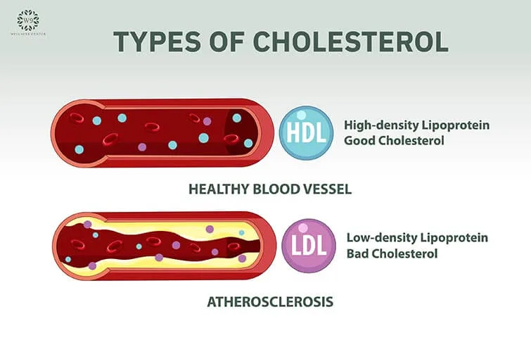ตรวจคอเลสเตอรอลเชิงลึก